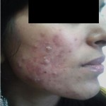 acne- after - first stage