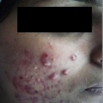 Acne- Before