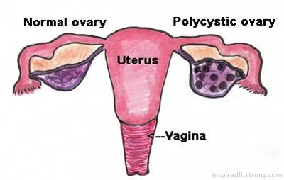 PCOS