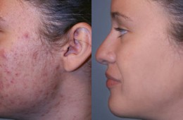 Treatment for acne scar
