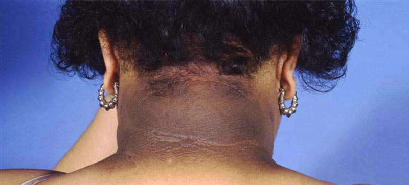 Treatment acanthosis nigricans Acanthosis Nigricans