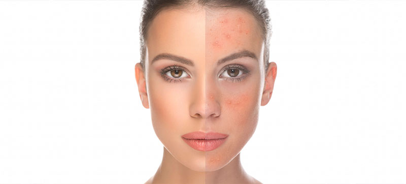 clear your skin from rashes img