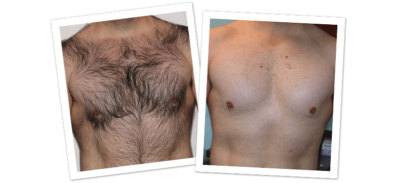 Laser Hair Removal For Men | Bangalore Laser Hair Removal For Men | Bangalore