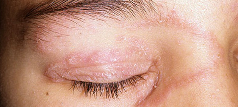 sikkerhedsstillelse præmie Initiativ What does a dry white itchy patch with redness indicate? - Dermatologist In  Bangalore