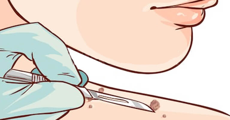 Skin Tag Removal - Dr Rasya Dixit