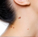 Skin Tags Removal