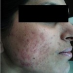 Acne - After - 2nd Stage