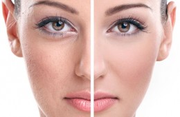 Facial Pigmentation Bangalore