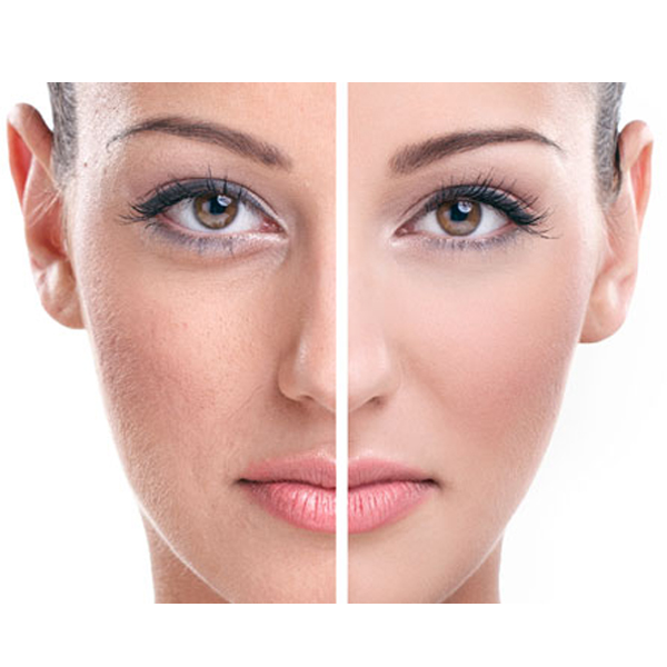 Facial Pigmentation Bangalore