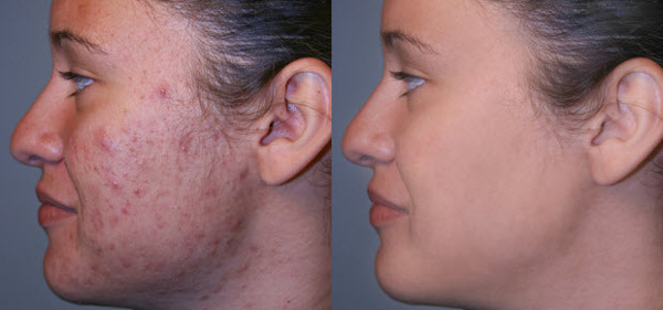 Treatment for acne scar