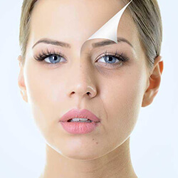 Chemical Peel new