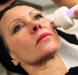 Radio Frequency Skin Lift