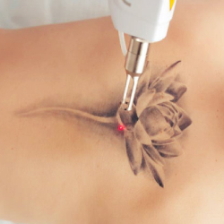 Tattoo removal