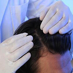 hair loss laser treatment